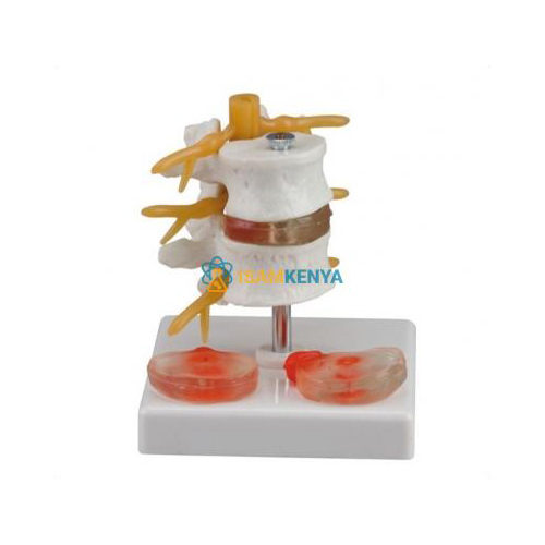 2 Lumbar Vertebrae with Hernia And Prolapsed Intervertebral Disc Model