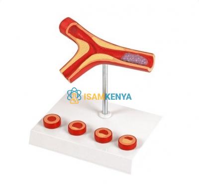 AtheroDAerosis and Thrombosis Model