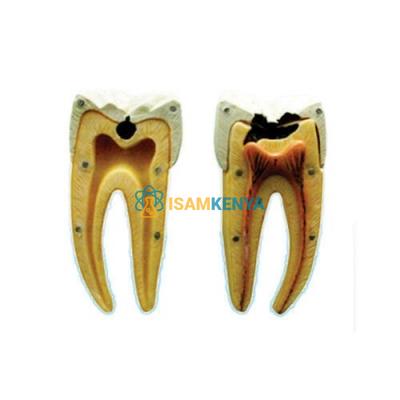 Dental Caries Model
