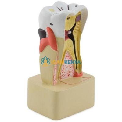Dental Pathology Model
