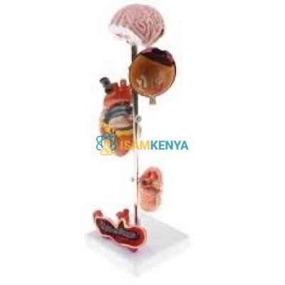 Hypertension Model 5-Parts