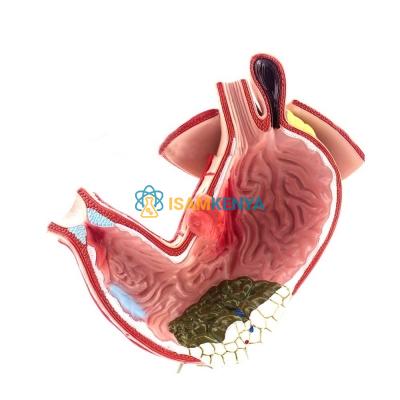 Gastric Diseases Model