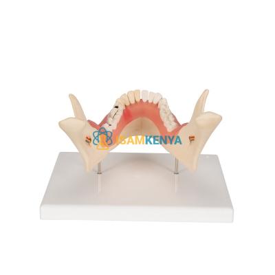 Human Teeth Model Dental Problems