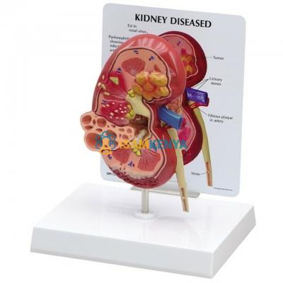 Nephron Diseases Model
