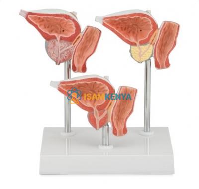 Normal and Diseased Prostate Gland Model