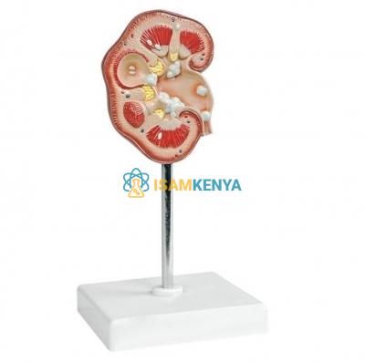Pathological Model of Renal Calculus