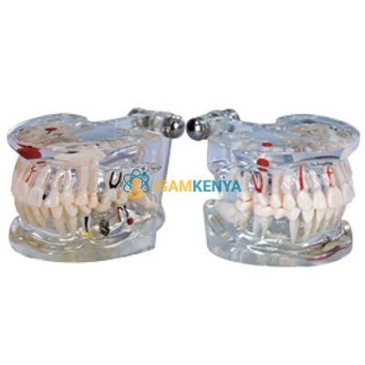 Pathology Teeth Model