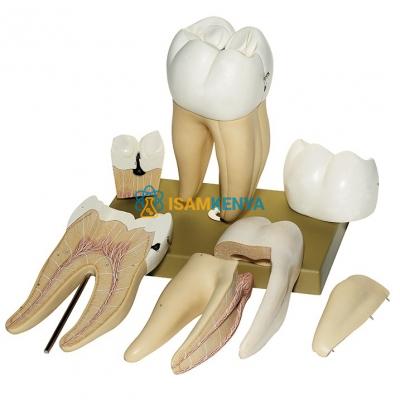 Right Lower First Molar Model