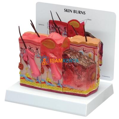 Skin Burn Normal Model