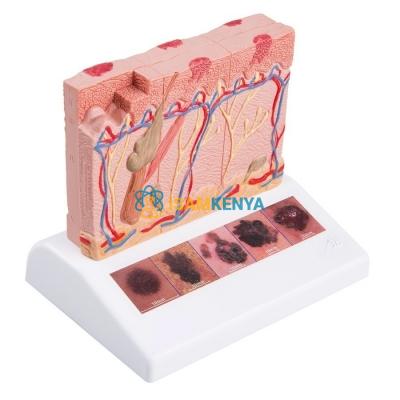 Skin Cancer Model