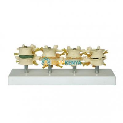 Stage Degenerative Lumbar Set